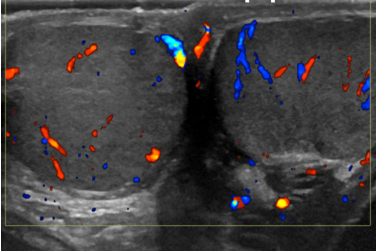 Ultrasound Evaluation of the Testicles